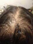 Androgenetic Alopecia - small