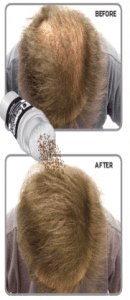 balding patches before after thumb
