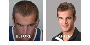 John Jack Anthony Hair Loss Before After