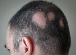 Alopecia Areata Male