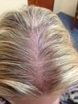 Androgenetic Alopecia after
