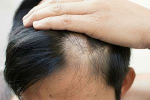 Oral Minoxidil - Treatment Tablets For Hair Loss & Alopecia