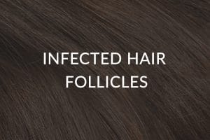 Infected Hair Treatment - Therapies To Prevent & Stop Hair Loss