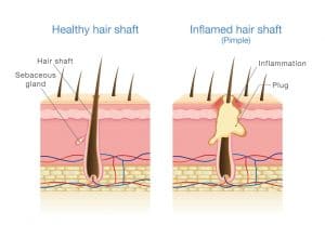 Inflamed Hair Shaft