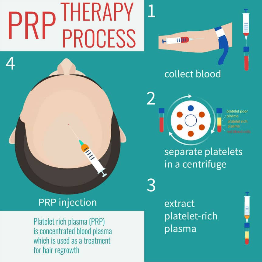 what-is-prp-treatment-therapy-procedure-for-hair-loss