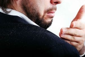 Dandruff And Hair Loss