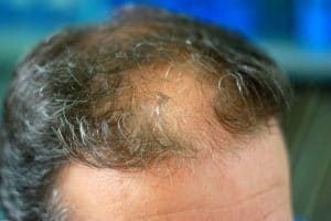 Hair-Implants-Cost-That-Everyone-Can-Afford-300x200