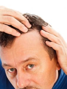 Hair Loss Symptoms