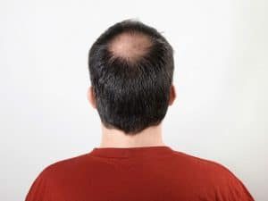 What is A Crown Hair Transplant
