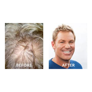 Shane Warne Before & After Hair Loss