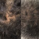 Ahc Prp 4 Treatments 6 Months Jpg