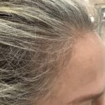 After Woman Hairline Jpg
