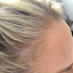 Before Woman Hairline Jpg Jpg