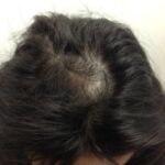 Female Client With Alopecia Areata After Rotated 1 Jpg