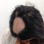 Female Client With Alopecia Areata Before Rotated 1 Jpg