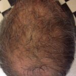 Prp 2 Before Jpg