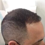 Surgery And Prp After Jpg